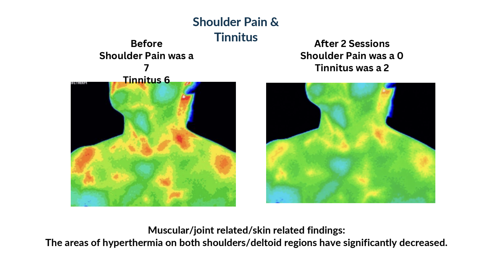Thermal scan of neck and shoulders before and after two sessions