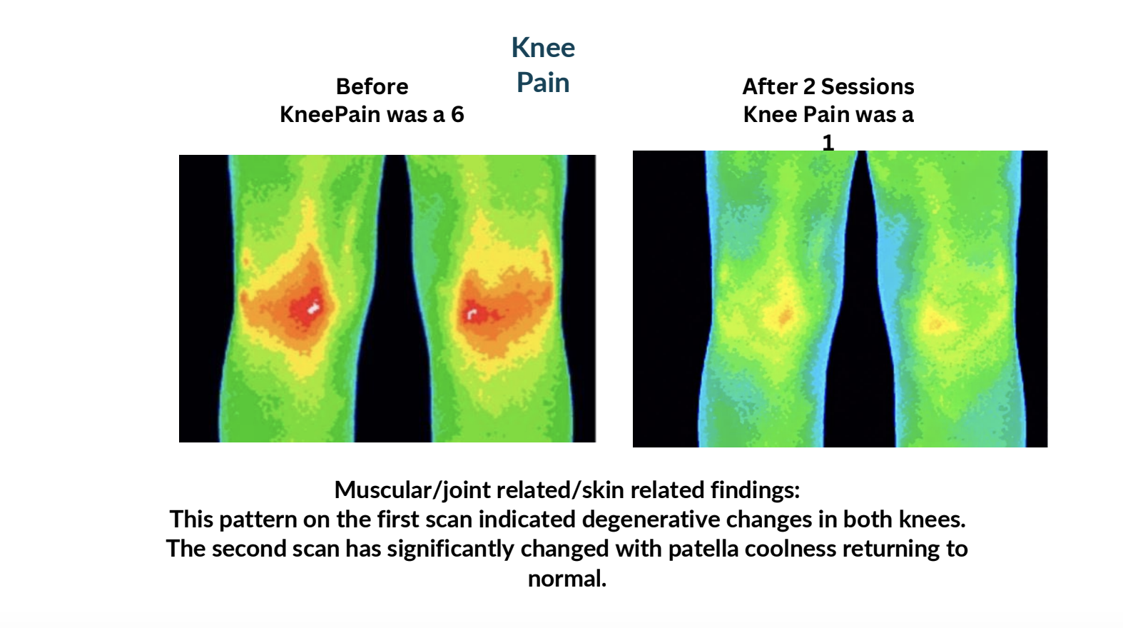 Thermal scan of knees before and after two sessions