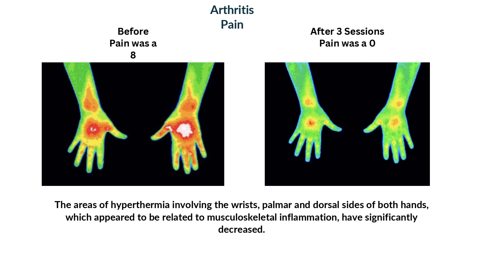 Thermal scan of hands before and after three sessions, with reduced heat