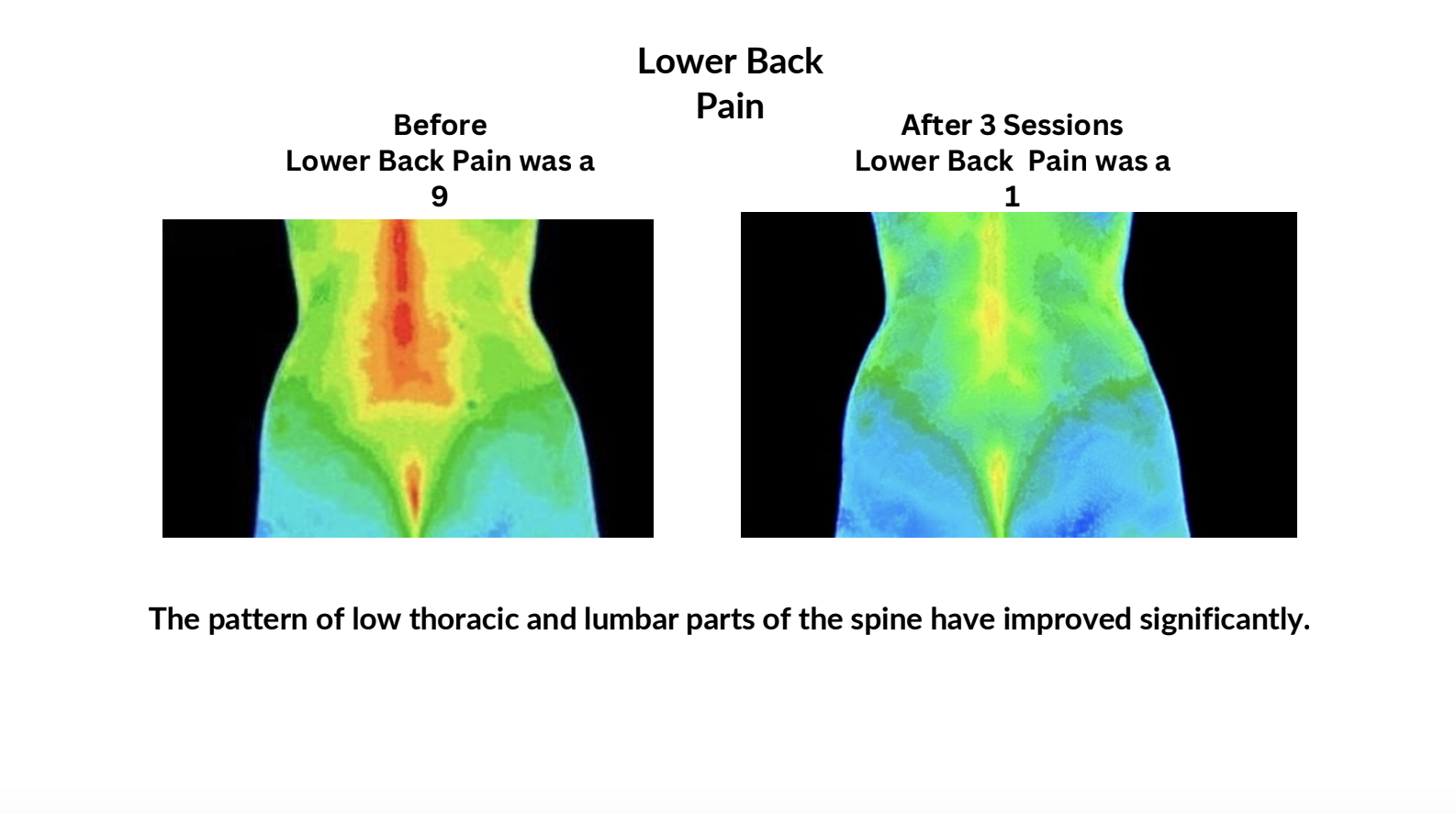 Thermal scan of lower back before and after three sessions, with reduced heat
